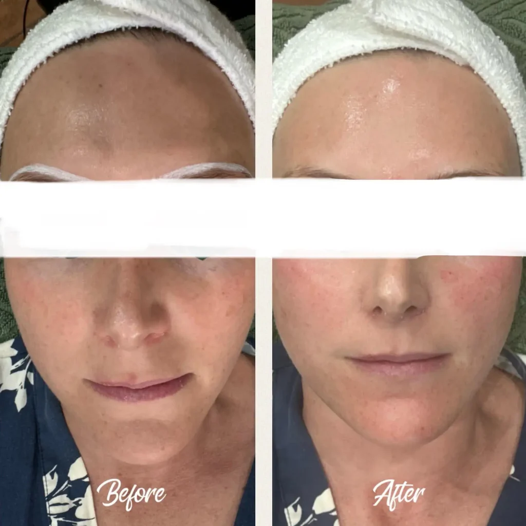Before and after Clearlift results at DermaNu Randburg