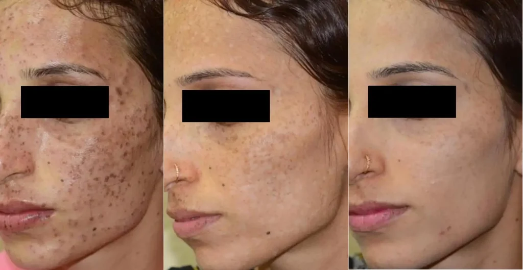 Before and after dermapen results at DermaNu Randburg
