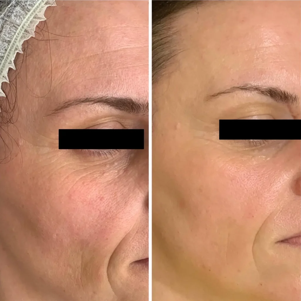 Before and after ClearLift results at DermaNu Randburg