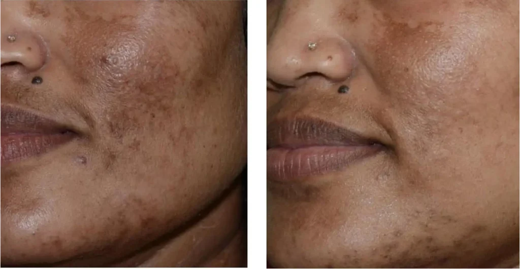 Before and after pigmentation lightening results at DermaNu Randburg