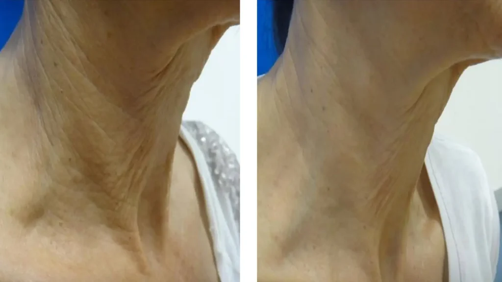 neck lift