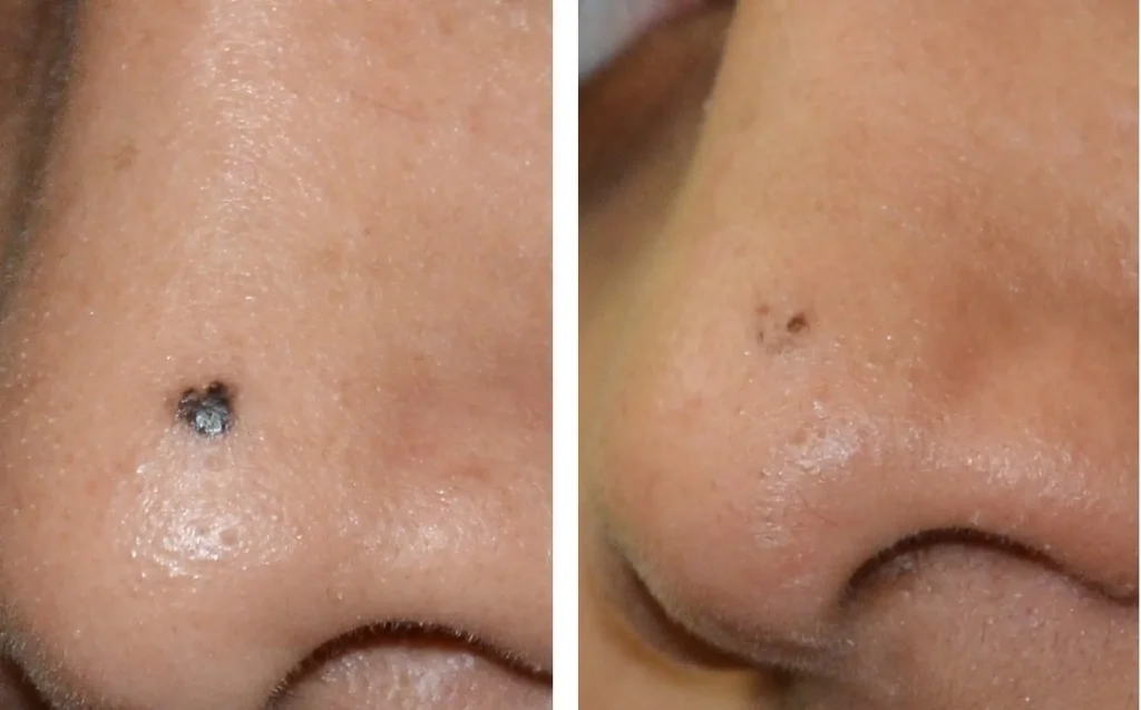Before and after DermaPen results at DermaNu Randburg