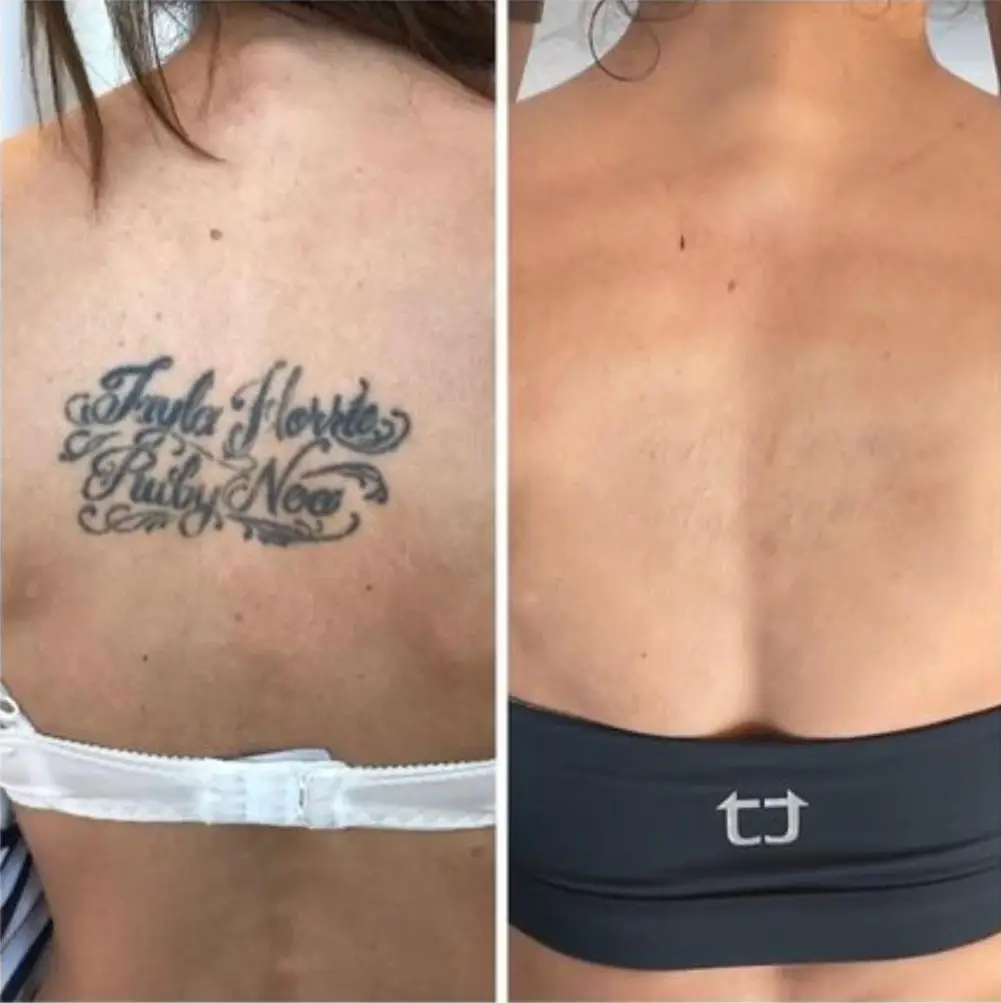 Before and after tattoo removal results at DermaNu Randburg